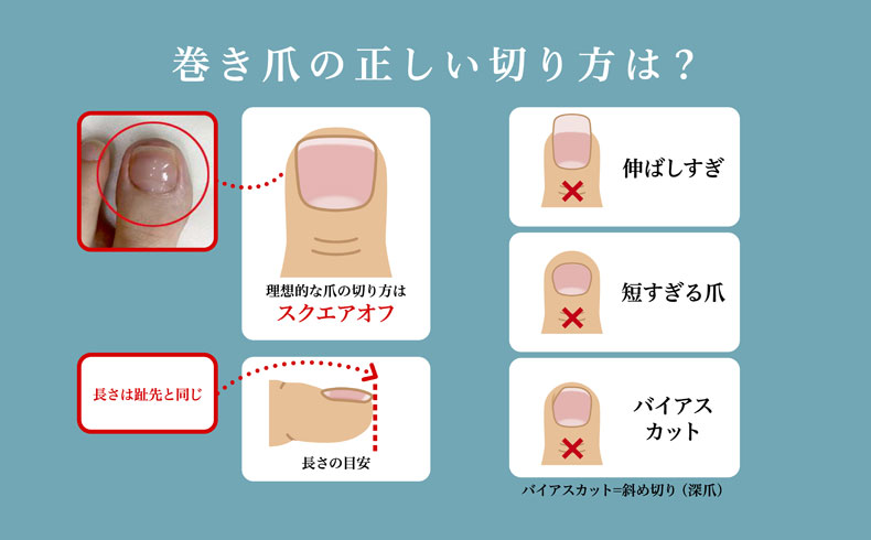 巻き爪の正しい切り方は？